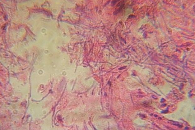 資料圖：口腔環(huán)境被厭氧菌感染導(dǎo)致口臭