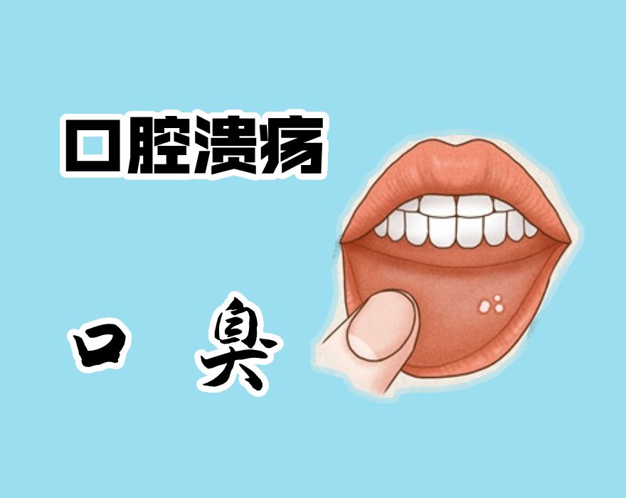 口腔潰瘍