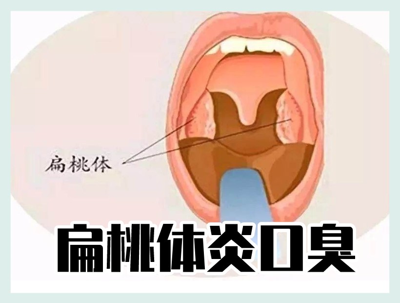 扁桃體實(shí)拍