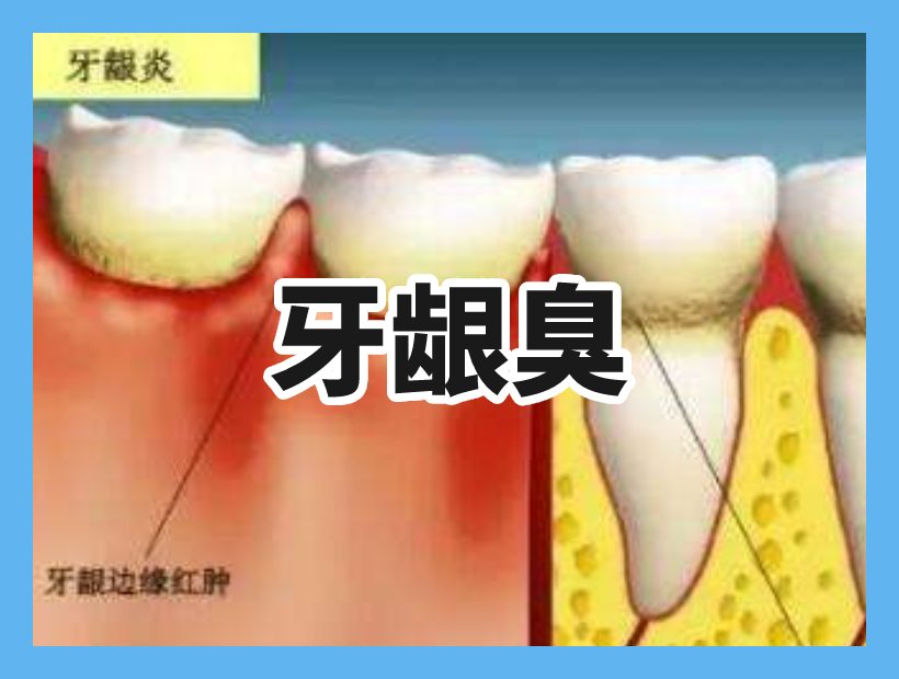 發(fā)炎的牙齦