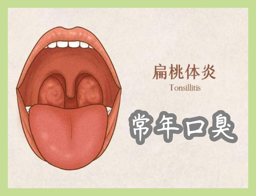 發(fā)炎的扁桃體