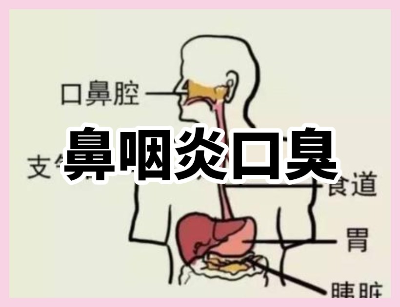 鼻咽炎口臭示意圖