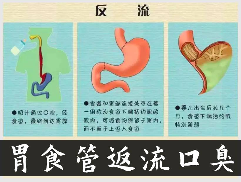 胃食管返流示意圖