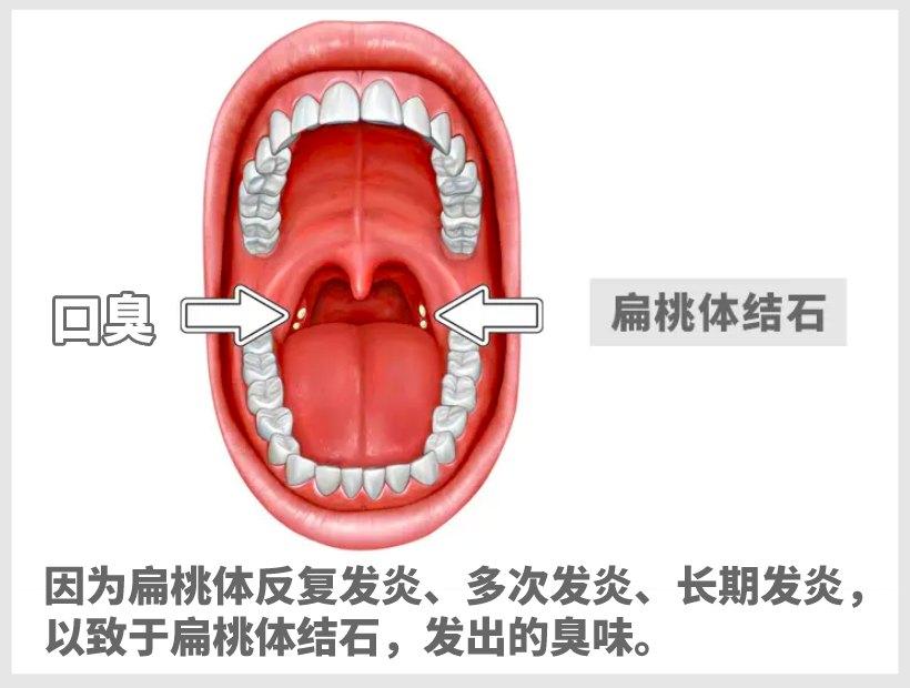 扁桃體結(jié)石位置圖
