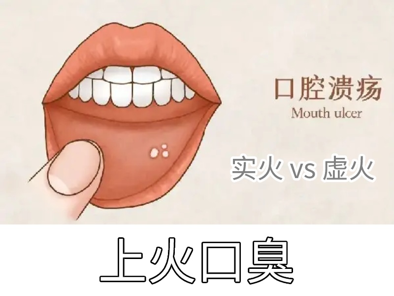 上火口臭分類圖