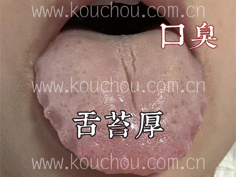 口臭舌苔