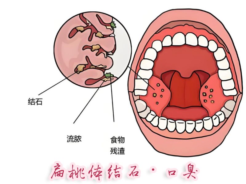 扁桃體結(jié)石與口臭